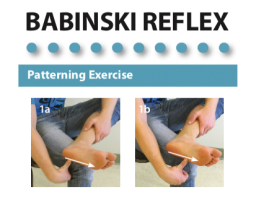 Babinski Reflex Exercise Handouts