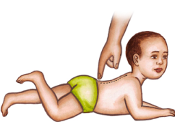MNRI Spinal Perez Reflex